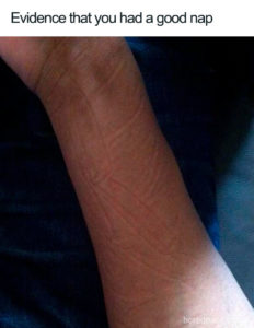 A picture of someone's arm with imprints of fabric all over their skin. The caption reads: "Evidence that you had a good nap."